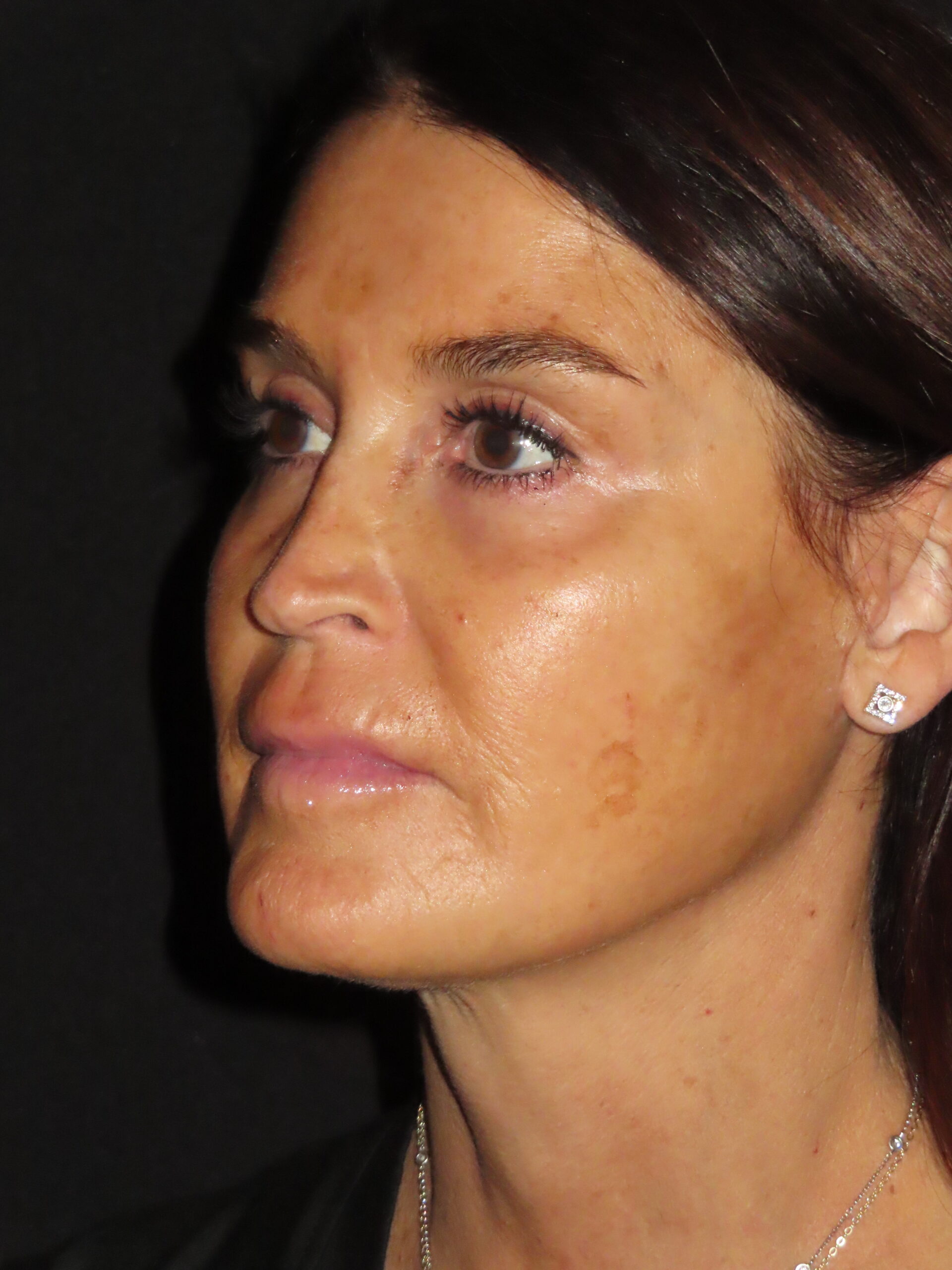 Facelift