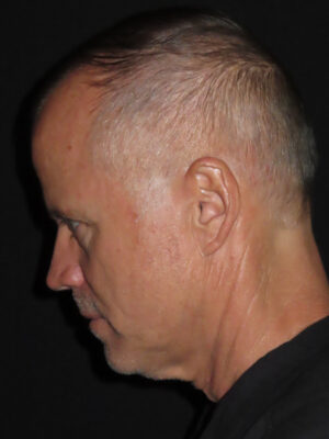 Face Procedures