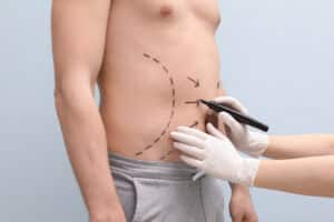 Doctor marking a man's abdomen with a marker, preparing for liposuction and body contouring procedure