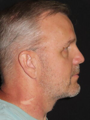 Face Procedures