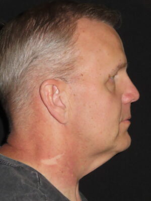 Face Procedures