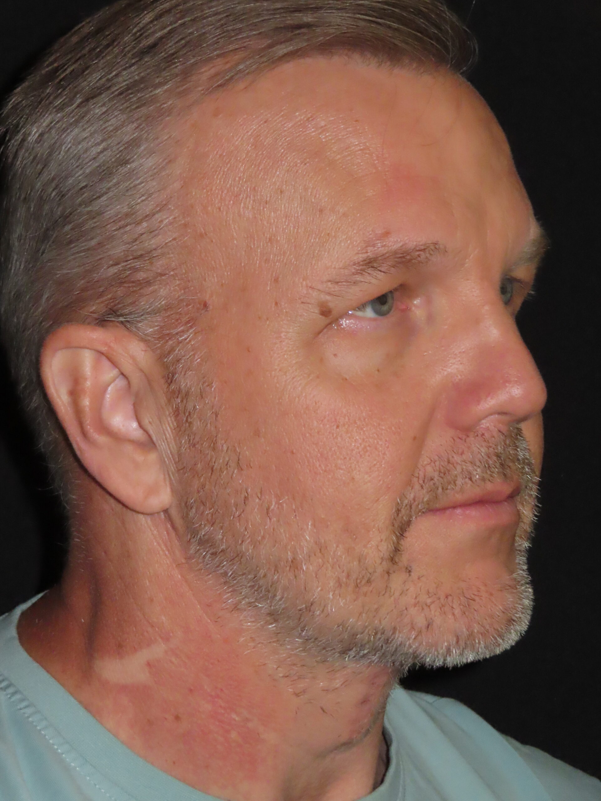 Face Procedures