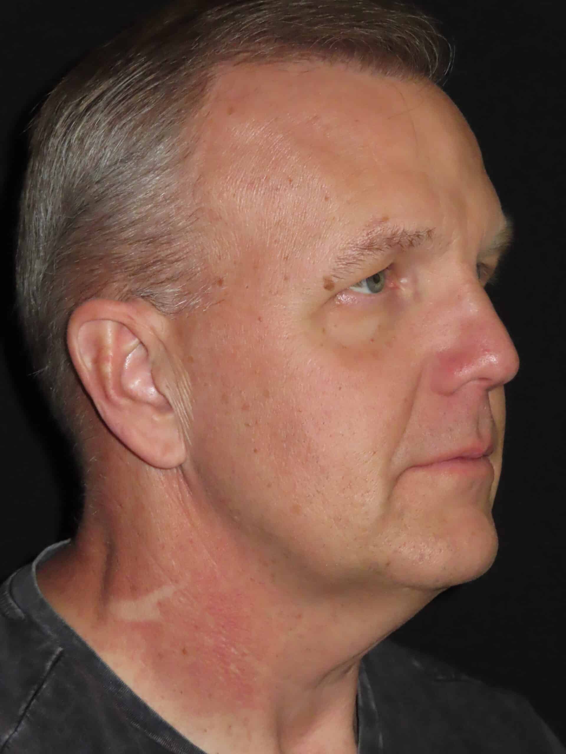 Face Procedures