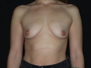 Breast Augmentation