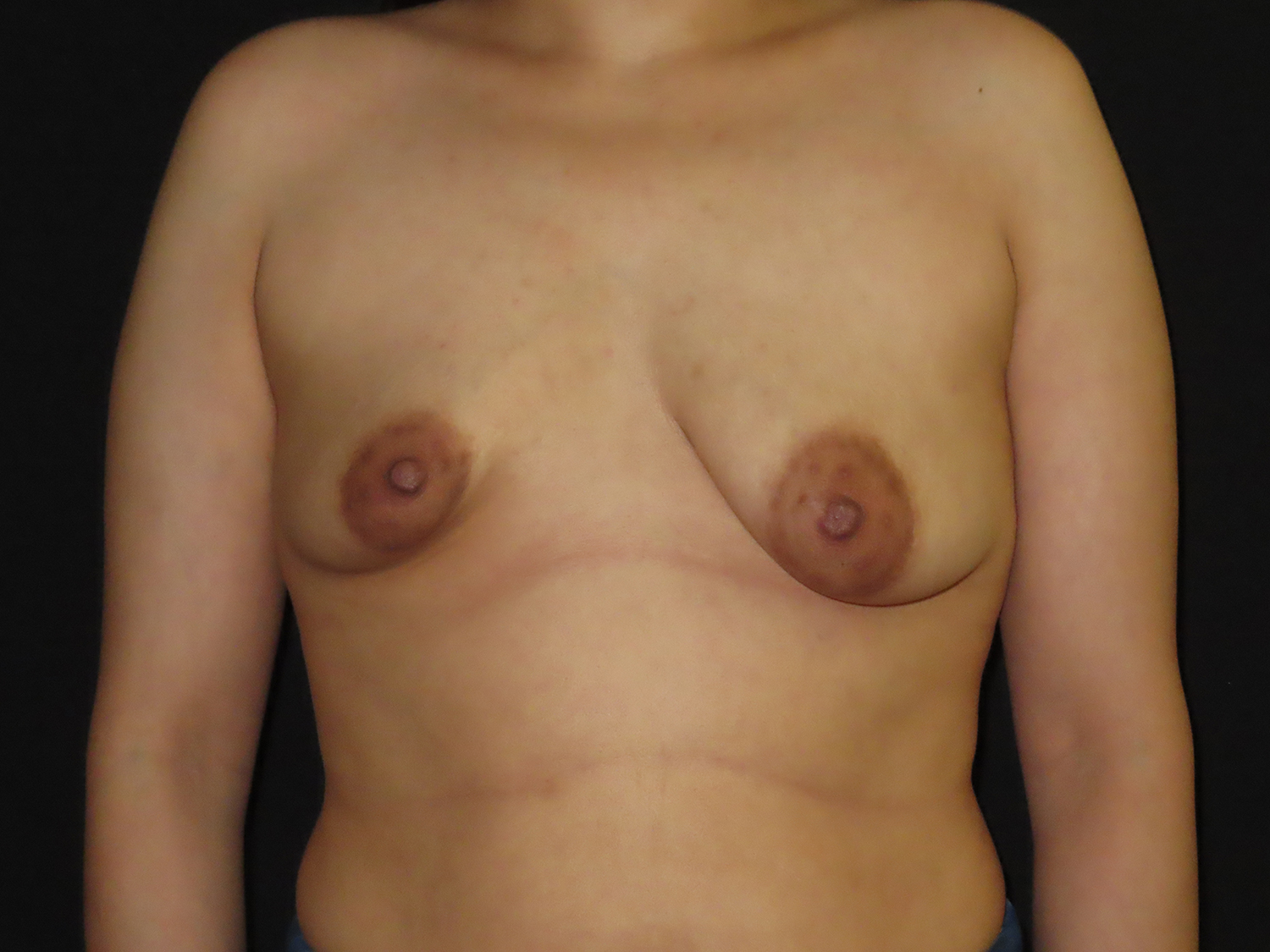 Breast Procedures