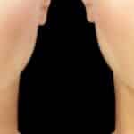 Illustration of the bullhorn-shaped incision pattern for a lip lift