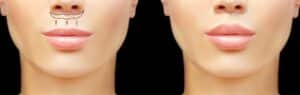 Illustration of the bullhorn-shaped incision pattern for a lip lift