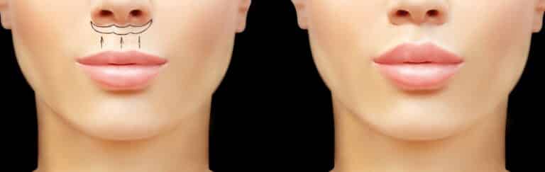 The Aging Lip: How a Lip Lift Reverses Time Without Overfilling