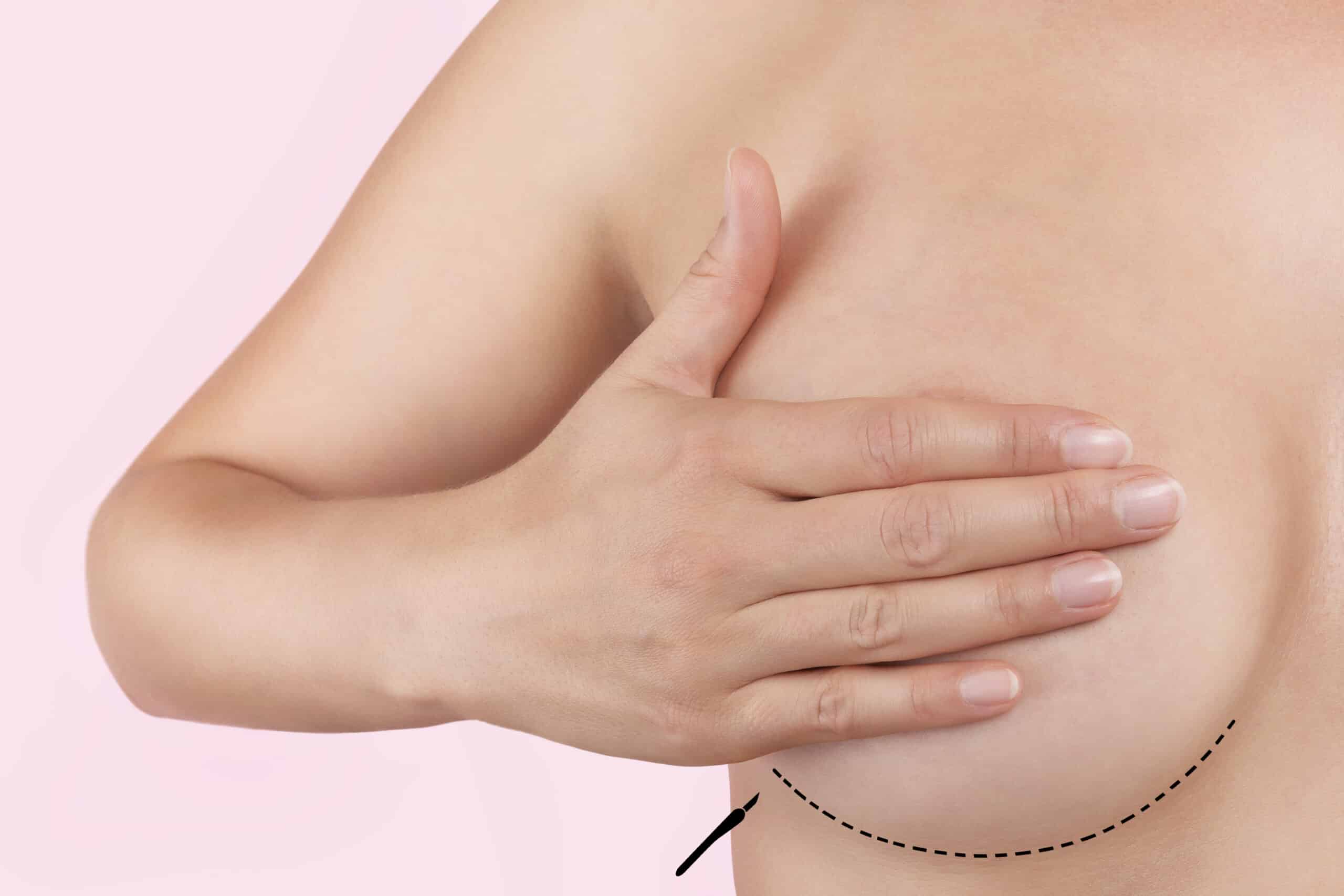 Woman holds one hand over her breast, with a black dotted line at the bottom of the breast before implant placement