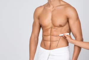 Surgeon draws lines on a man's abdomen before male liposuction for a six pack