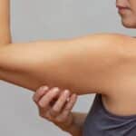 Woman pinches upper arm skin in Scottsdale prior to an arm lift