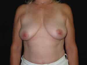 Breast Implant Removal