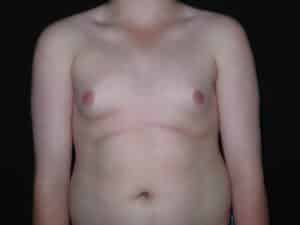 Male Breast Reduction - Gynecomastia