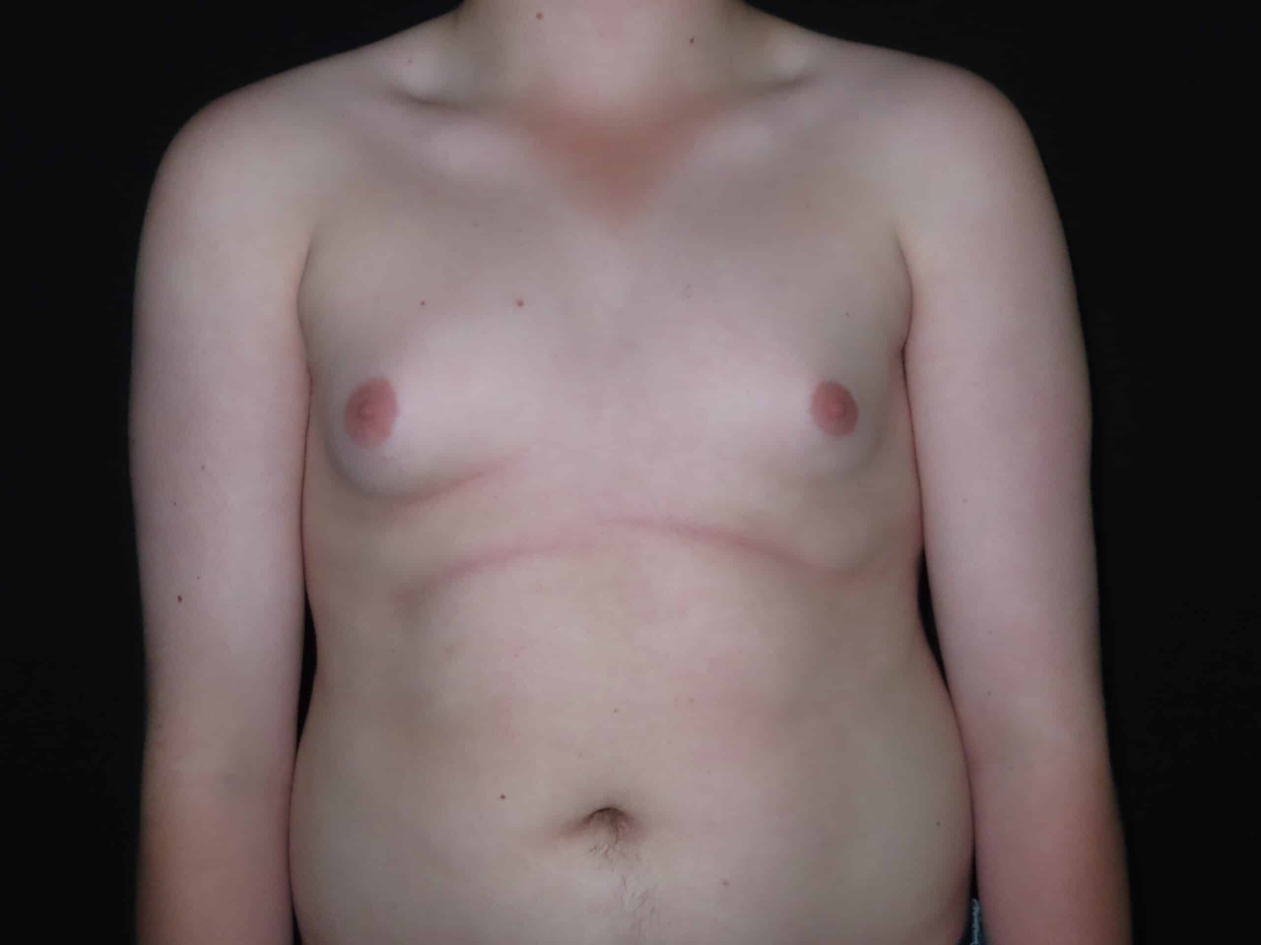 Male Breast Reduction - Gynecomastia