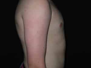 Male Breast Reduction - Gynecomastia
