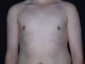 Male Breast Reduction - Gynecomastia