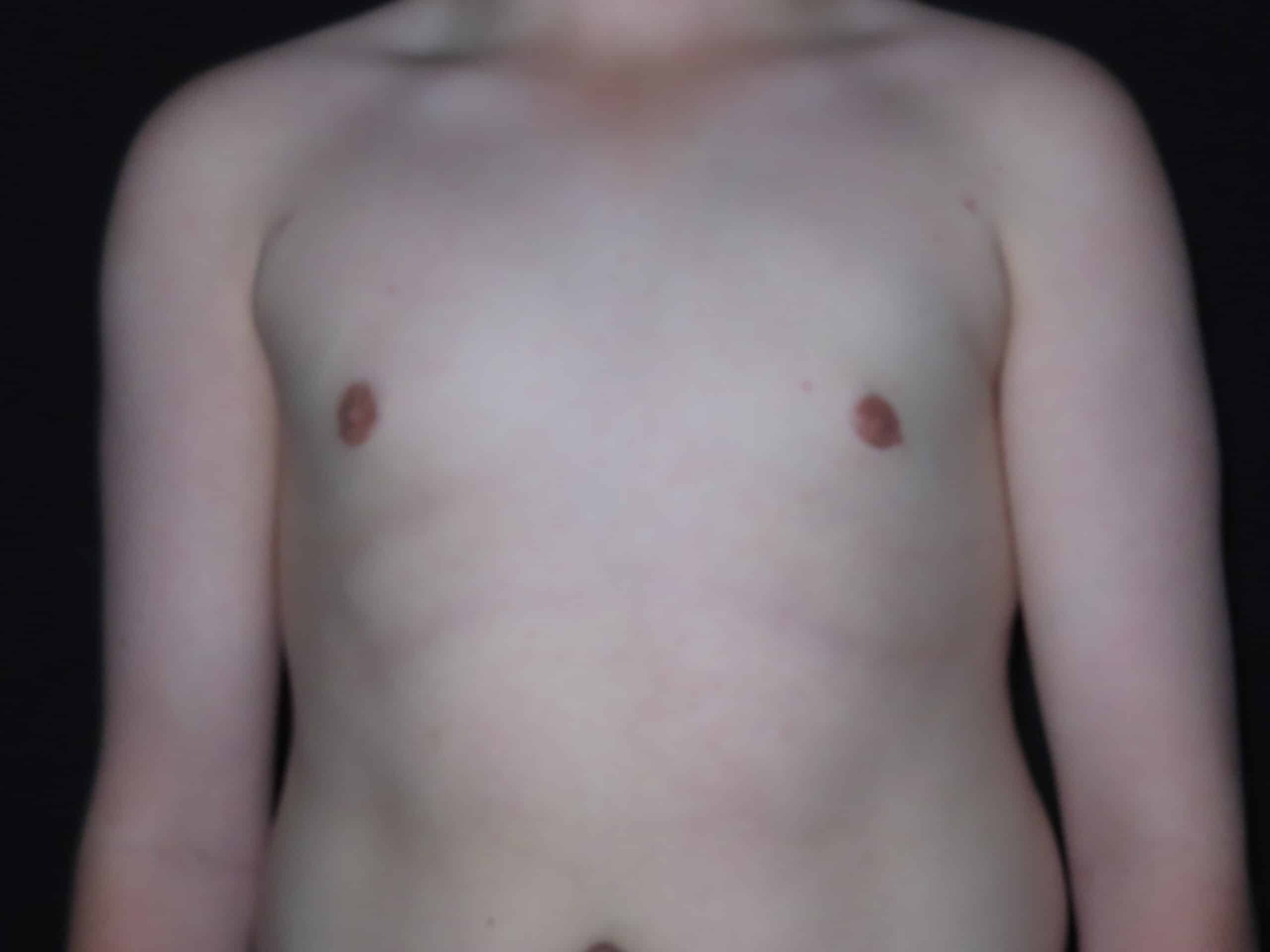 Male Breast Reduction - Gynecomastia