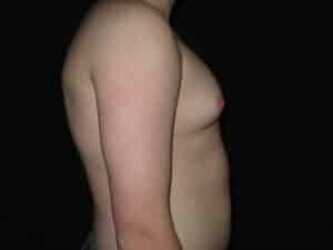 Male Breast Reduction - Gynecomastia