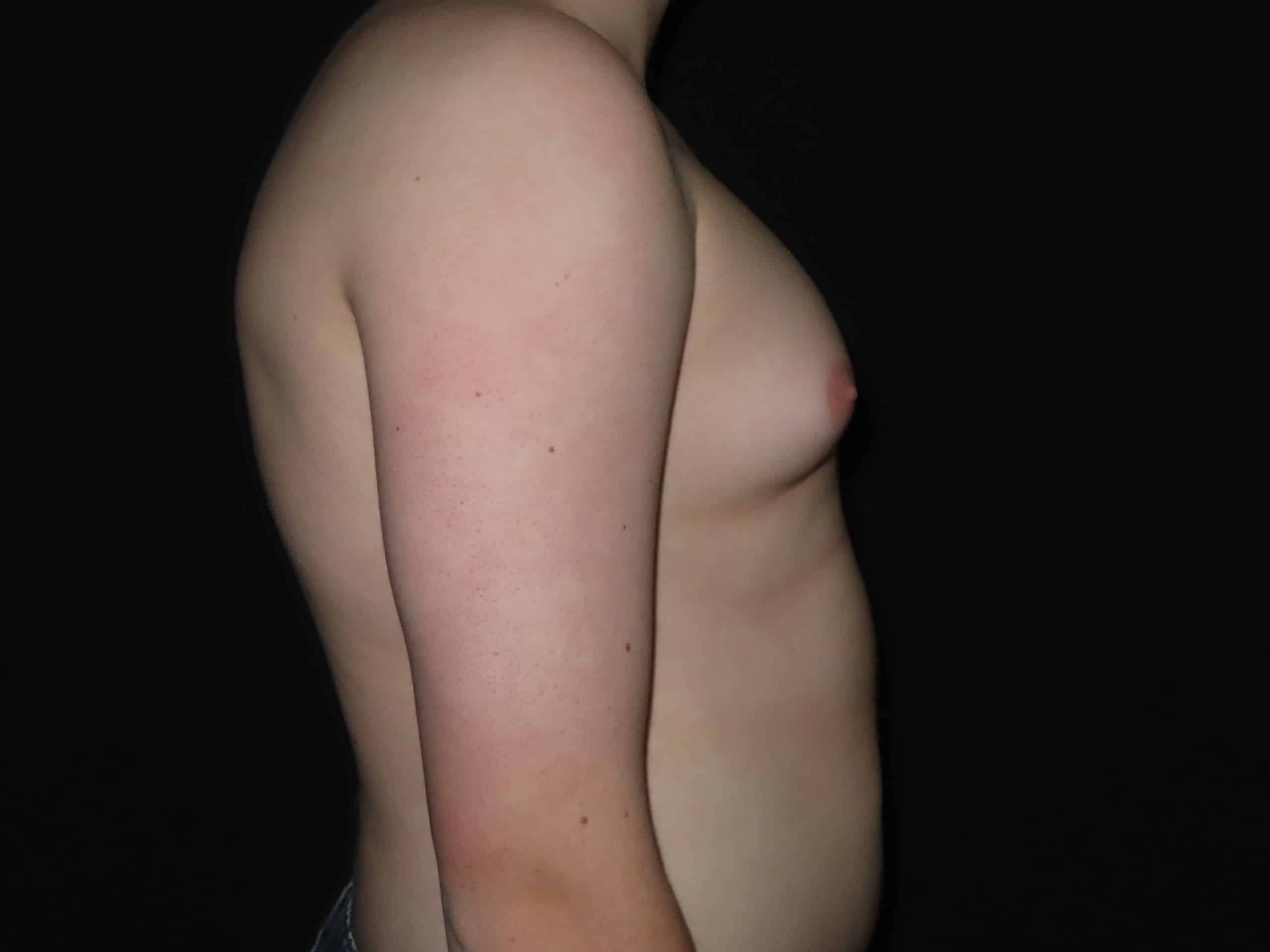 Male Breast Reduction - Gynecomastia