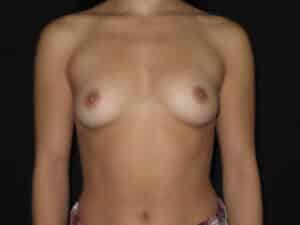 Breast Augmentation