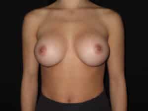 Breast Augmentation