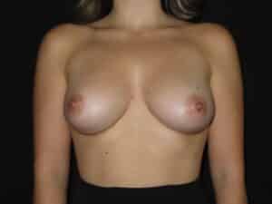 Breast Augmentation
