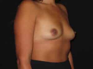 Breast Augmentation