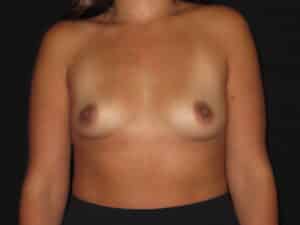 Breast Augmentation