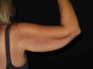Brachioplasty (Arm Lift)