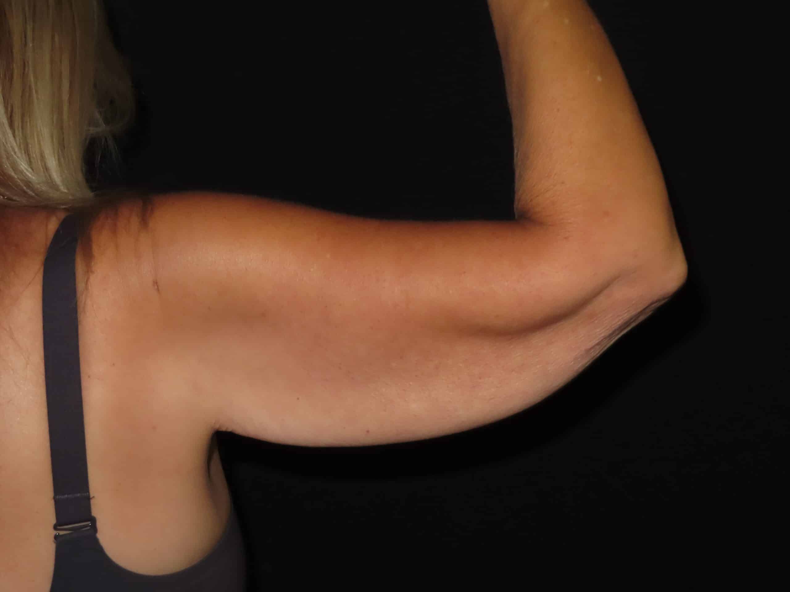 Brachioplasty (Arm Lift)