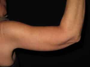 Brachioplasty (Arm Lift)