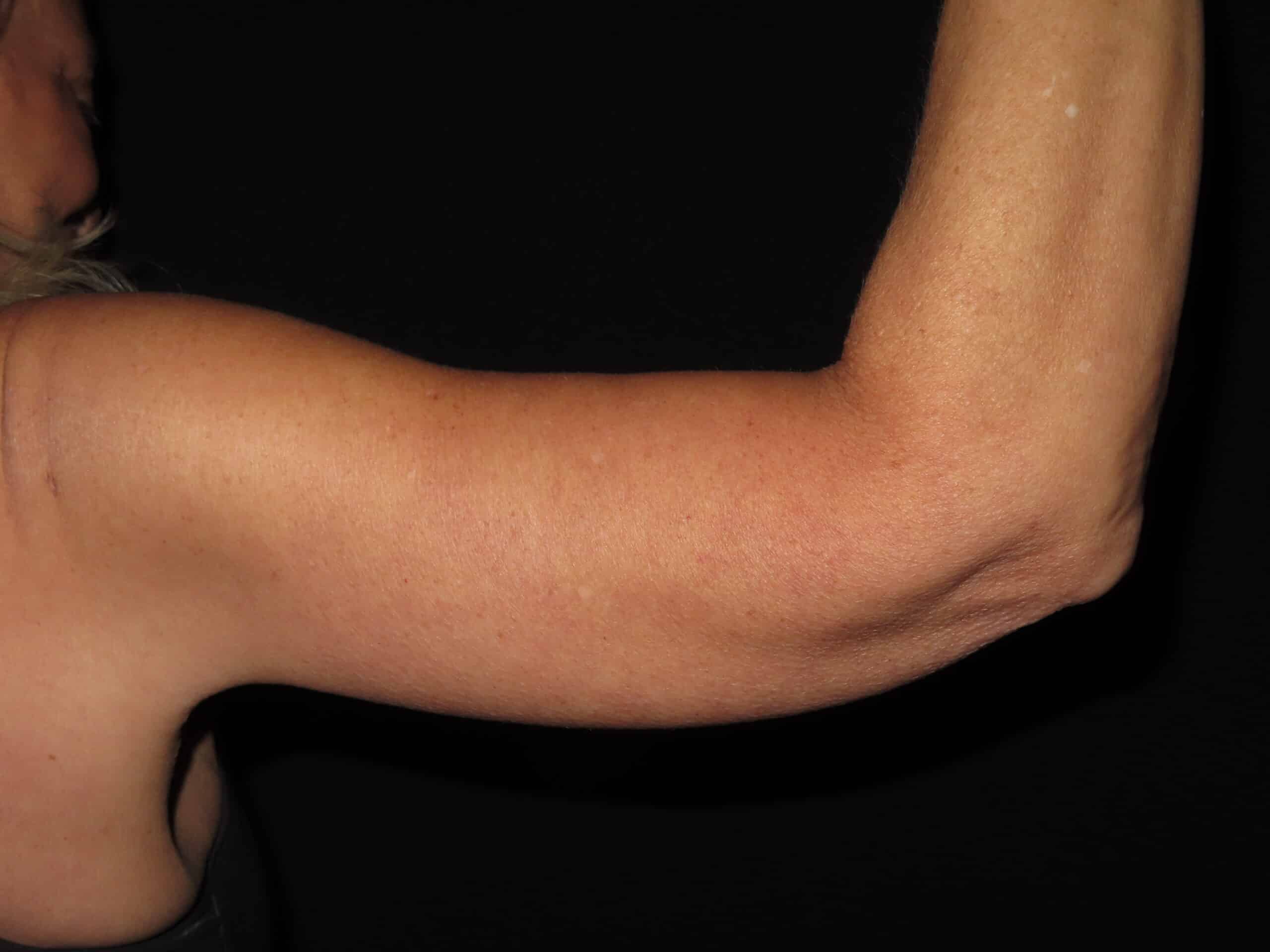 Brachioplasty (Arm Lift)