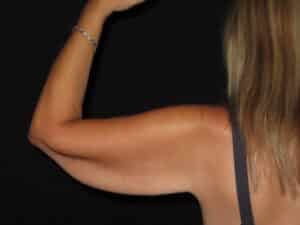 Brachioplasty (Arm Lift)