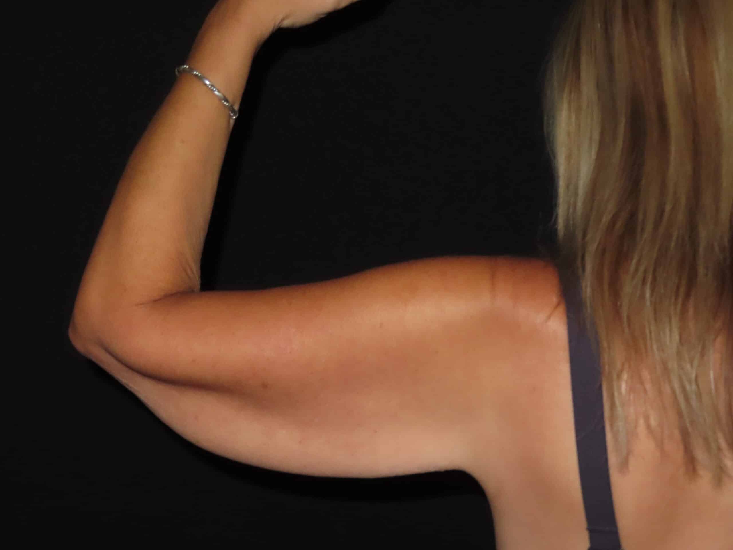 Brachioplasty (Arm Lift)