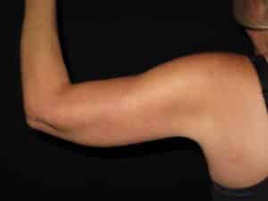 Brachioplasty (Arm Lift)