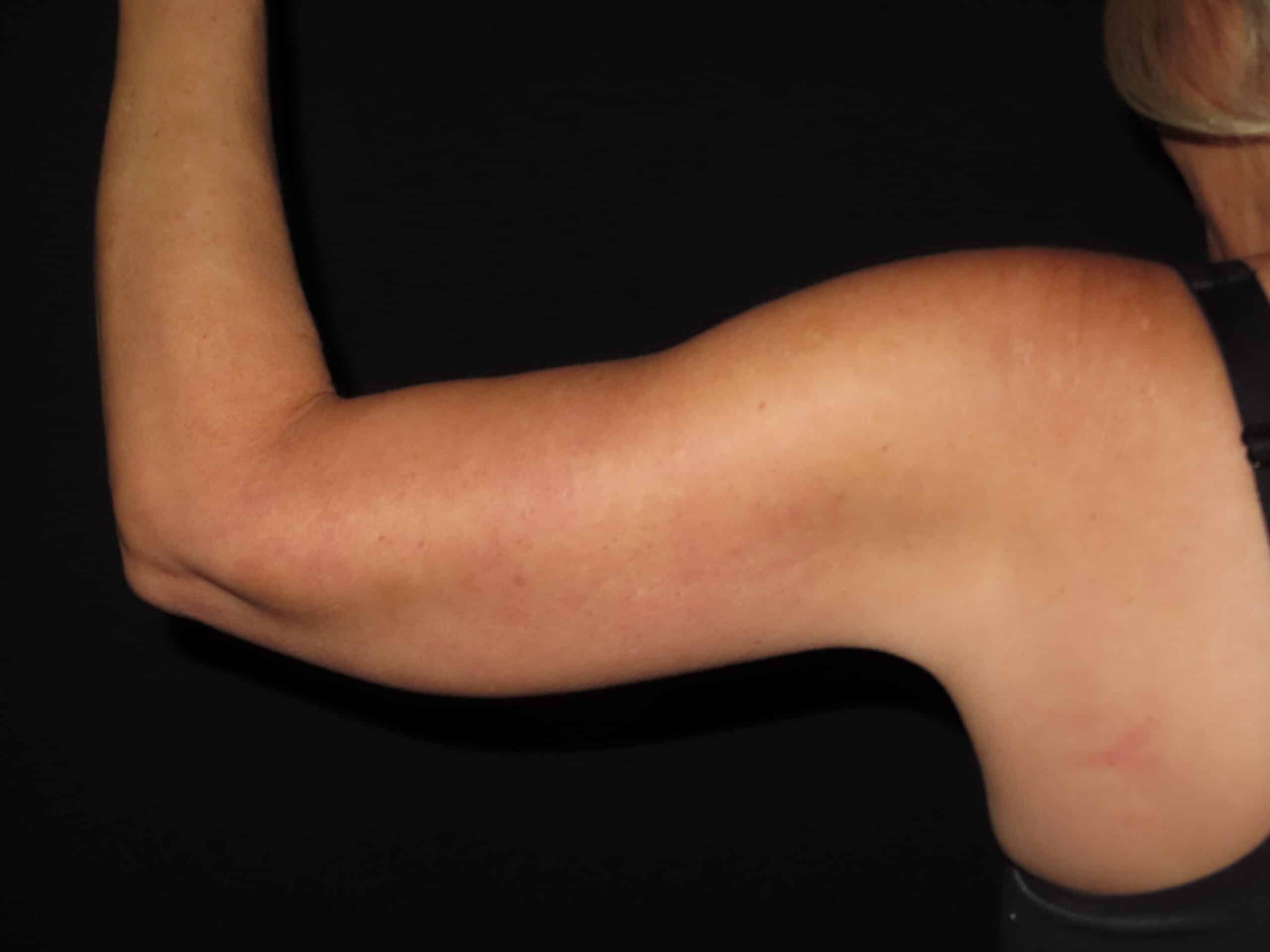 Brachioplasty (Arm Lift)