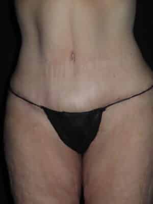 Body Procedures