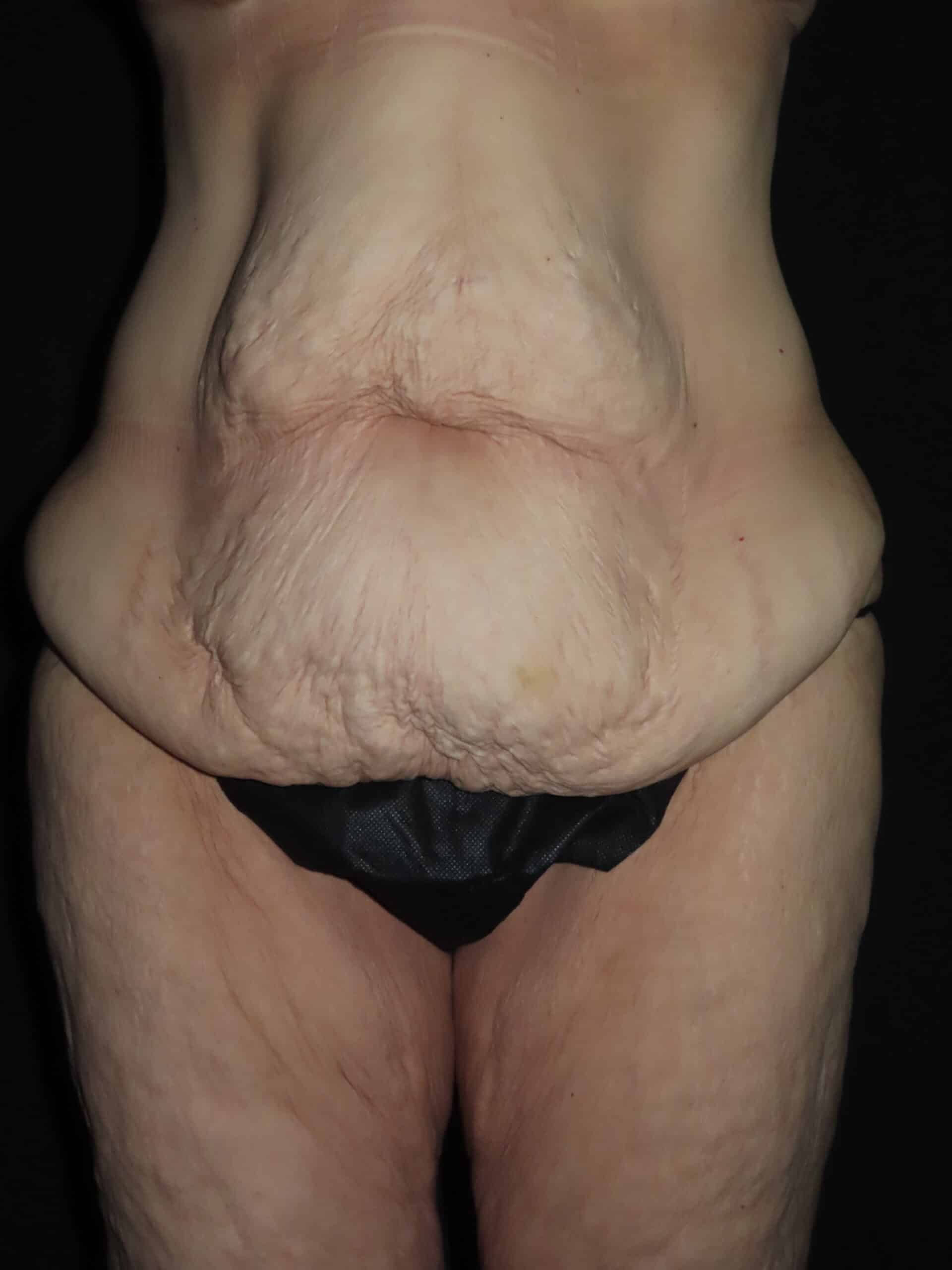 Body Procedures