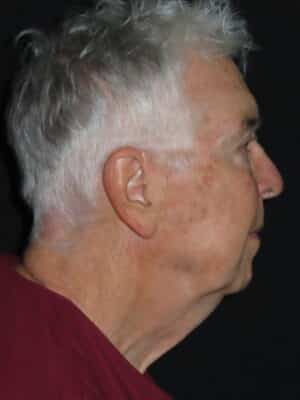 Face Procedures