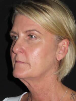 Facelift