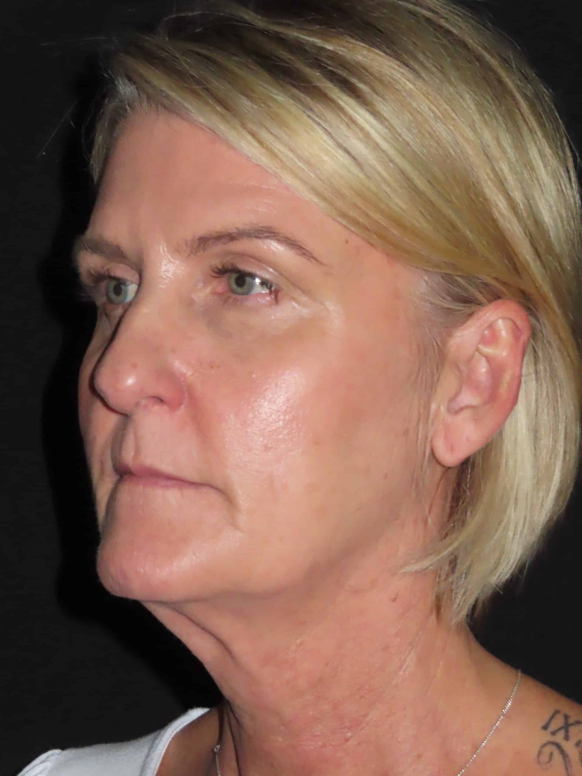 Facelift