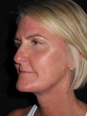 Facelift