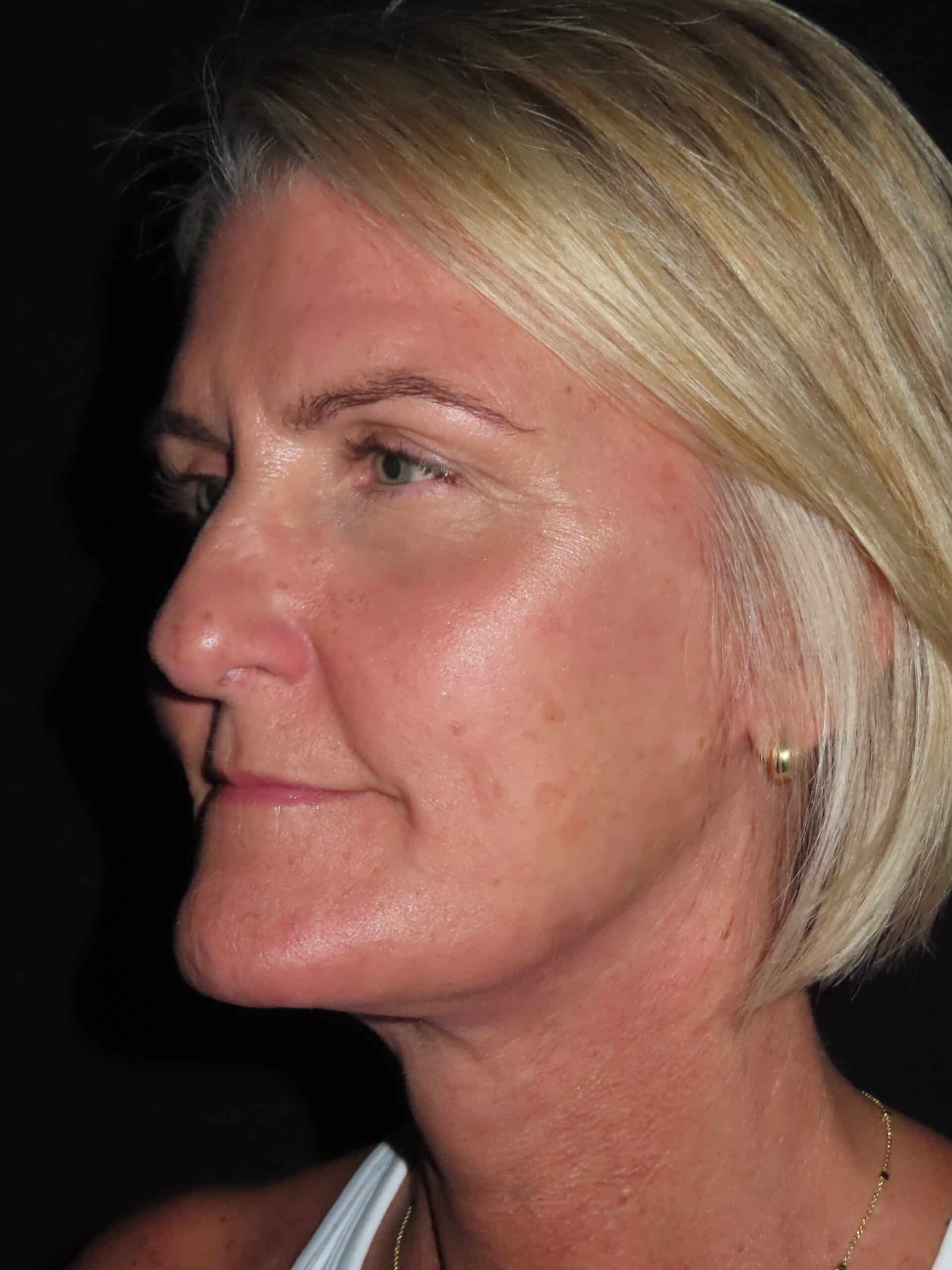 Facelift
