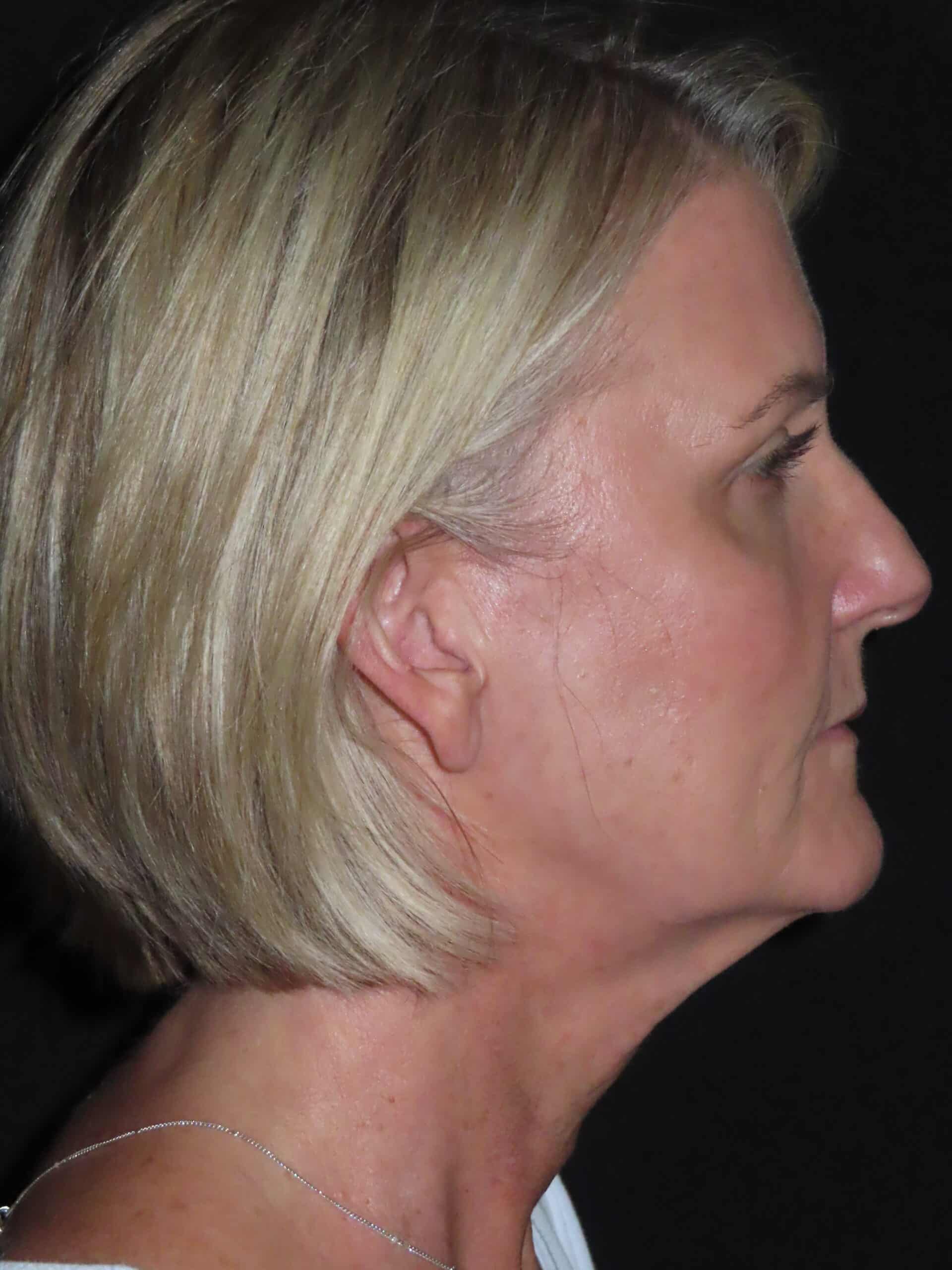 Facelift