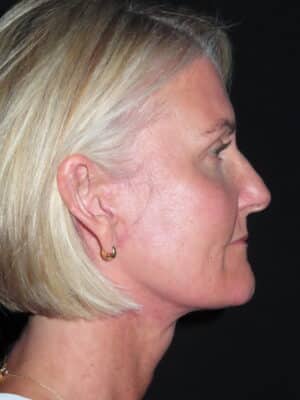 Facelift