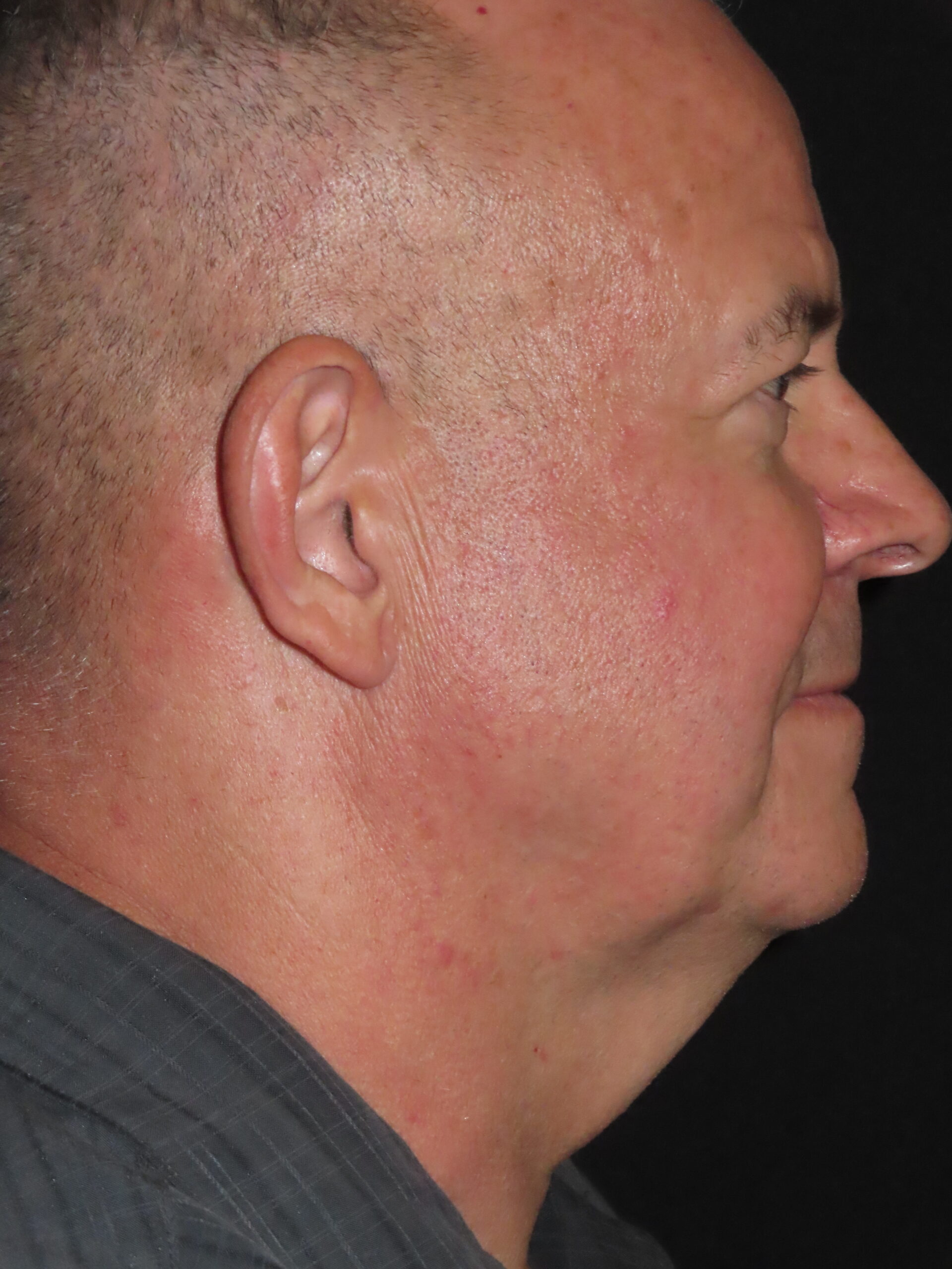 Facelift