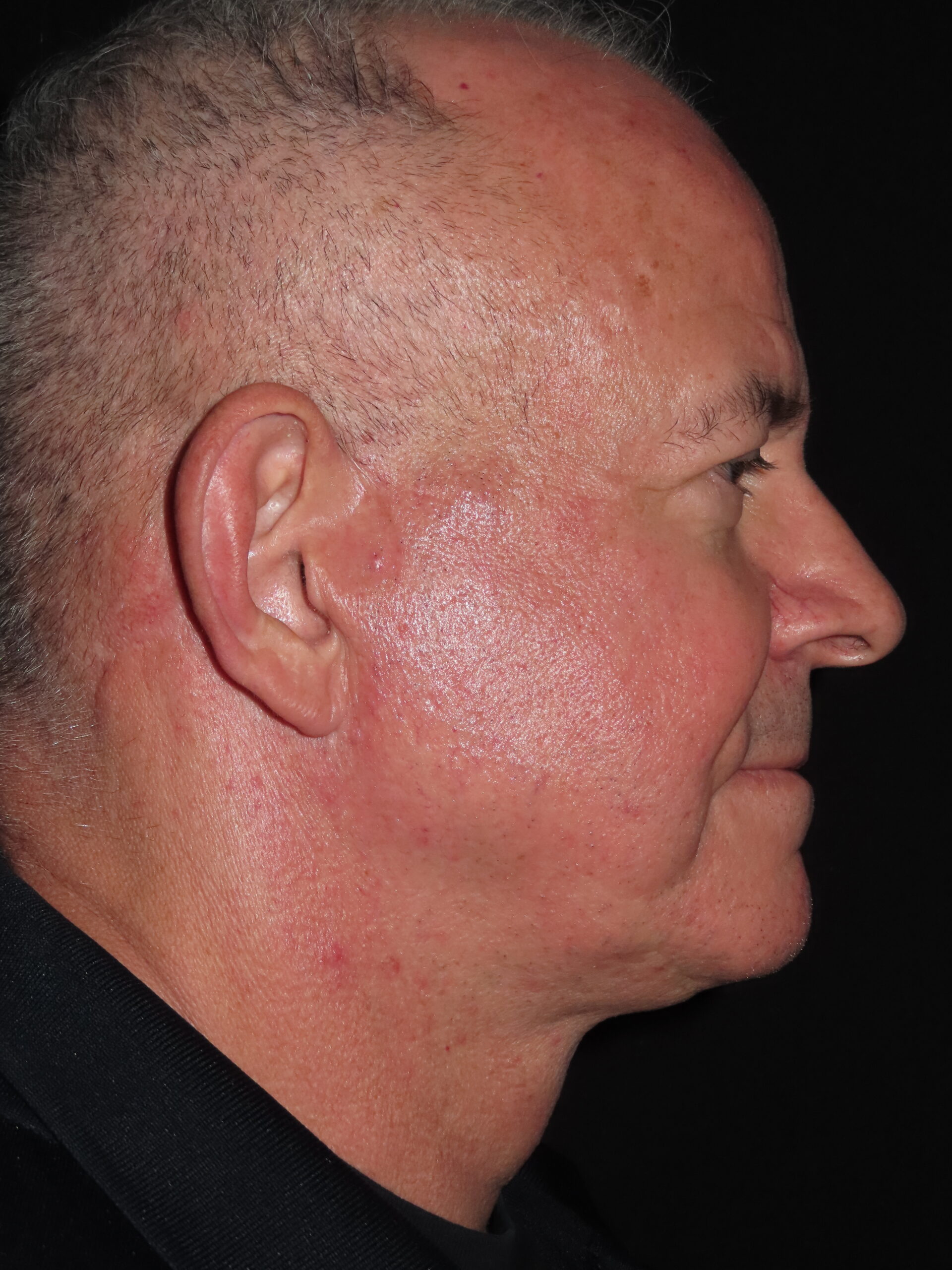 Facelift