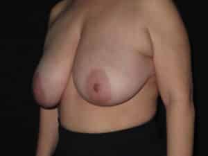Breast Procedures