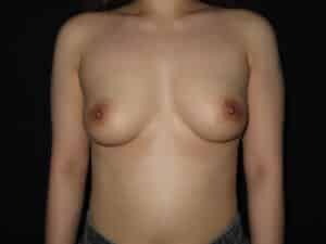 Breast Augmentation