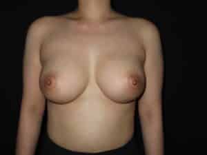 Breast Augmentation